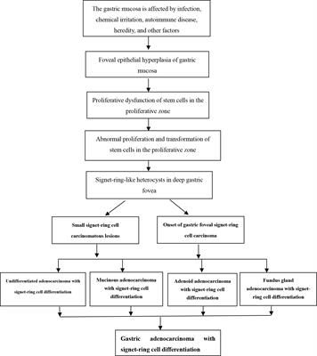 Early onset, development and histological features of gastric signet-ring cell carcinoma